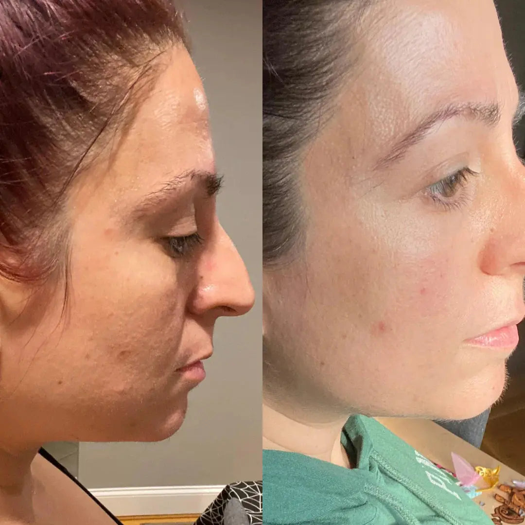 Side-by-side comparison of a woman's face with and without visible makeup, showing skin texture and acne.